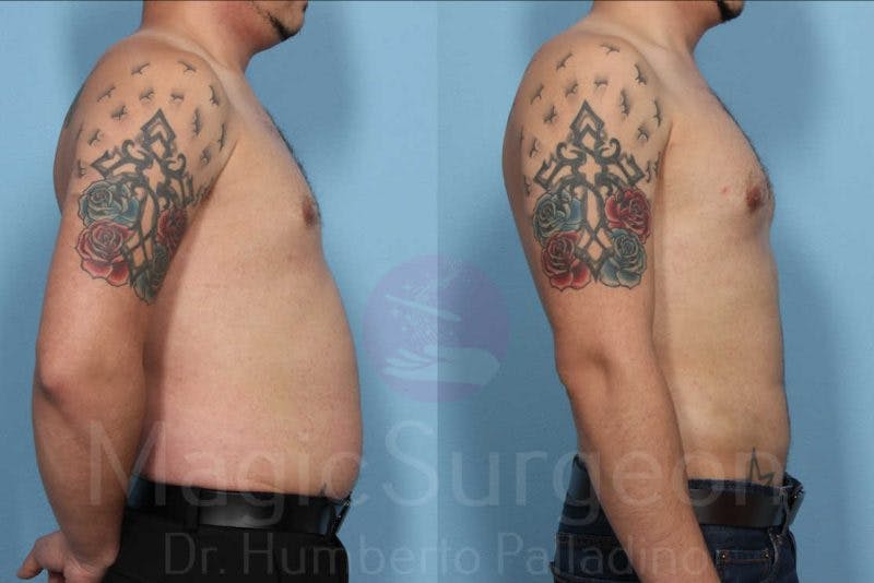Liposuction Before & After Gallery - Patient 133182335 - Image 3