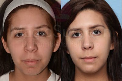 Chin Augmentation Before & After Gallery - Patient 133182340 - Image 1