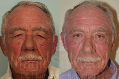 Blepharoplasty Before & After Gallery - Patient 133182341 - Image 1