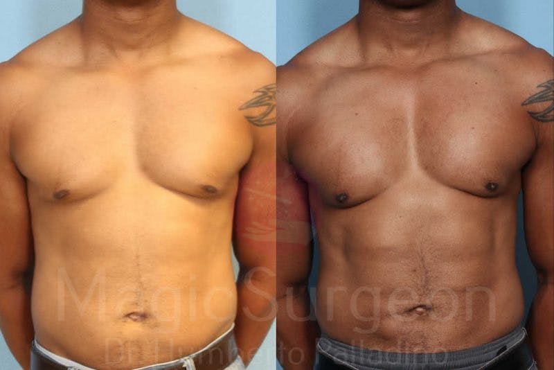 Liposuction Before & After Gallery - Patient 133182338 - Image 1