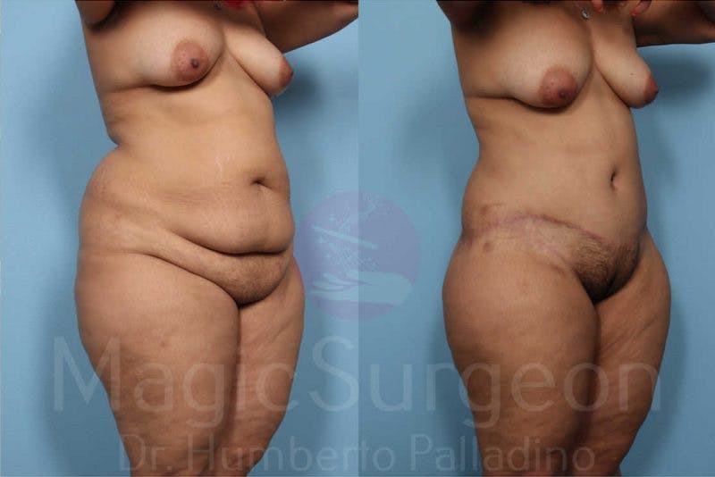 Tummy Tuck Before & After Gallery - Patient 133182339 - Image 5