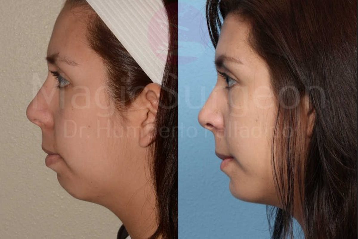 Chin Augmentation Before & After Gallery - Patient 133182340 - Image 2