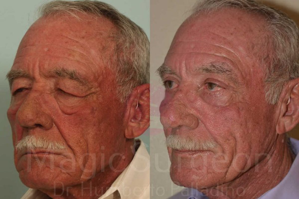 Blepharoplasty Before & After Gallery - Patient 133182341 - Image 2