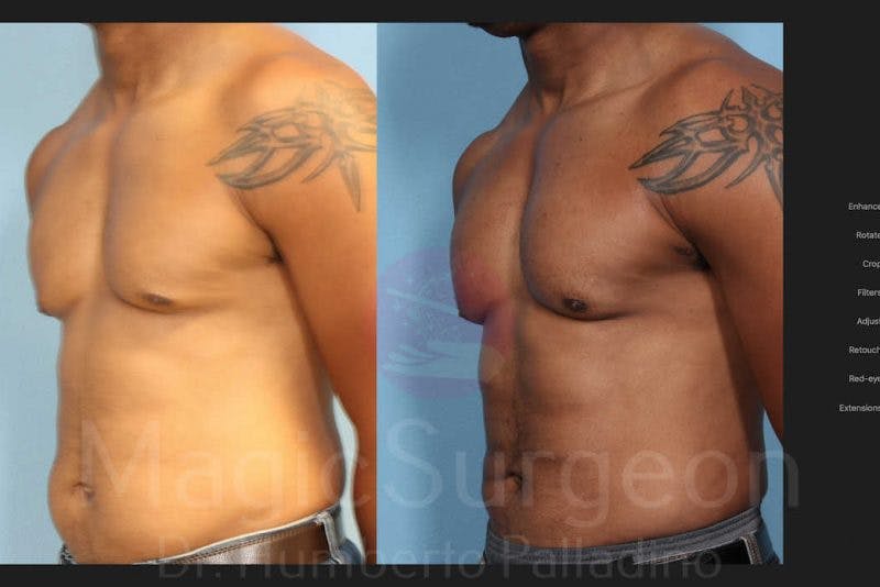 Liposuction Before & After Gallery - Patient 133182338 - Image 2