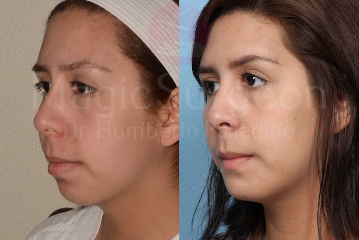 Chin Augmentation Before & After Gallery - Patient 133182340 - Image 3