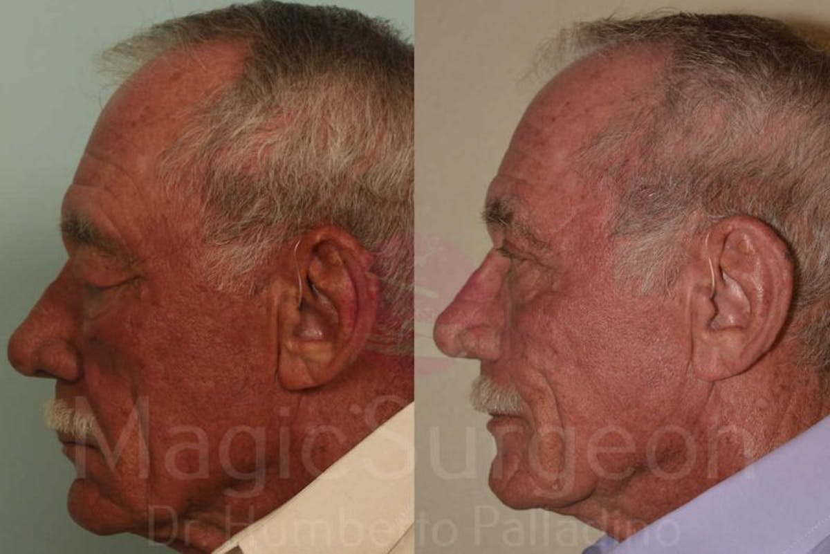 Blepharoplasty Before & After Gallery - Patient 133182341 - Image 3