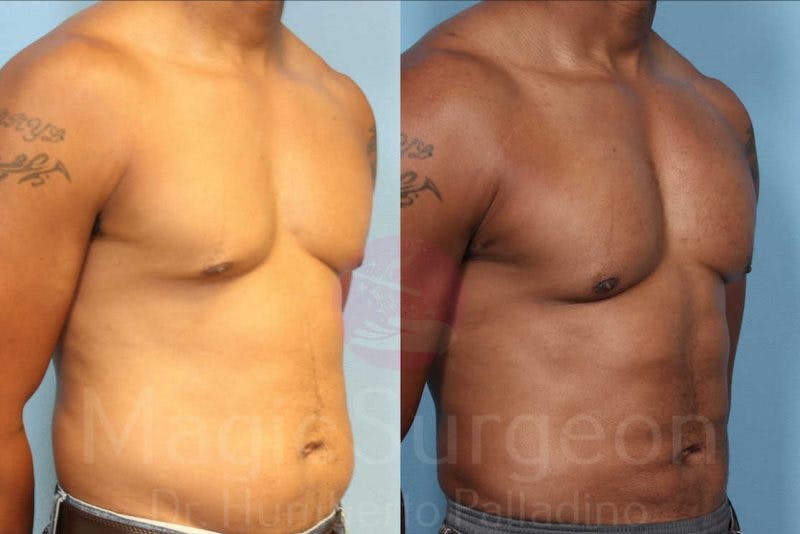 Liposuction Before & After Gallery - Patient 133182338 - Image 3