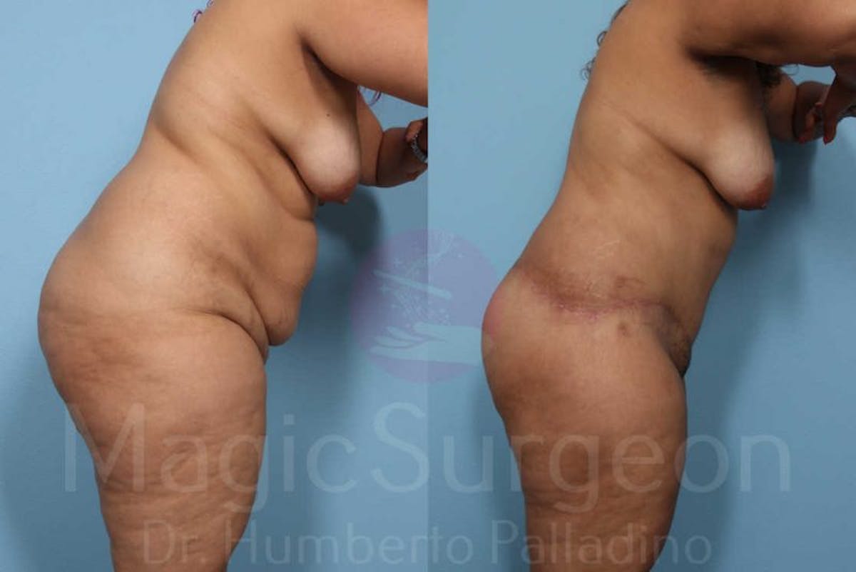 Tummy Tuck Before & After Gallery - Patient 133182339 - Image 7