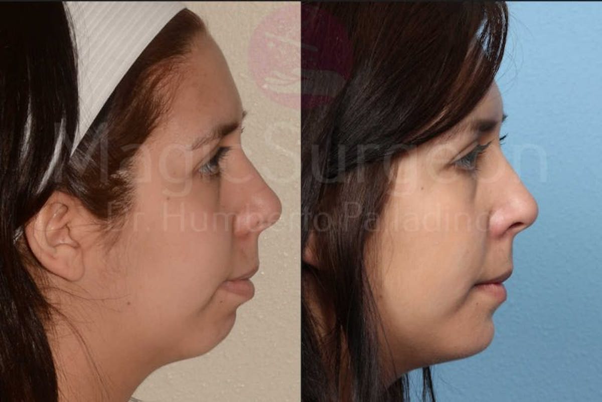 Chin Augmentation Before & After Gallery - Patient 133182340 - Image 4