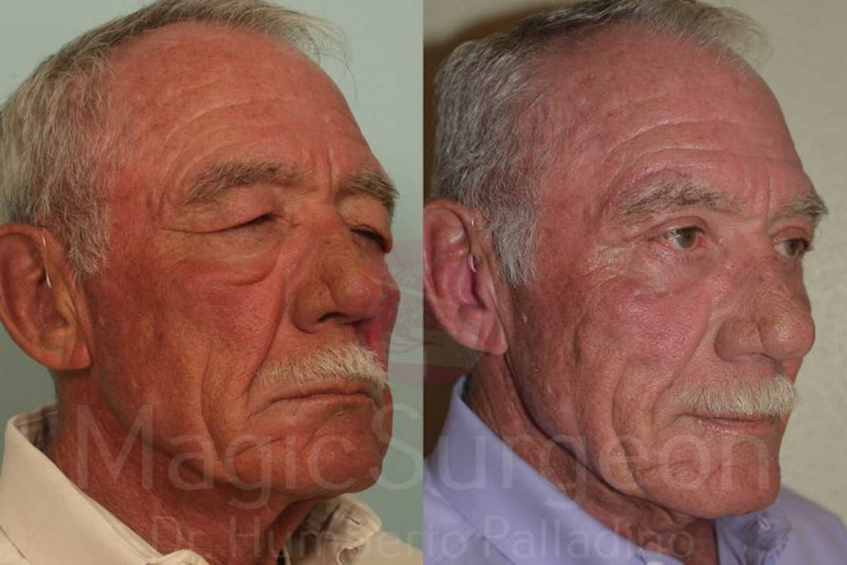 Blepharoplasty Before & After Gallery - Patient 133182341 - Image 4