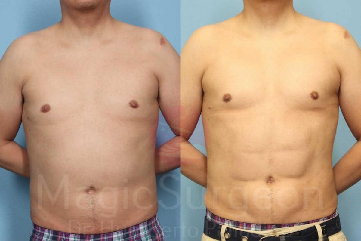 Liposuction Before & After Gallery - Patient 133182342 - Image 1