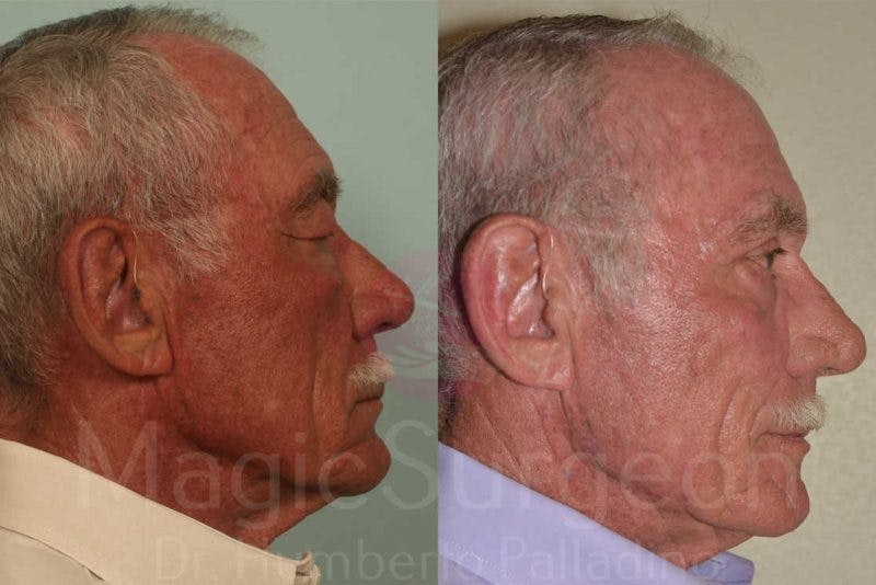 Blepharoplasty Before & After Gallery - Patient 133182341 - Image 5