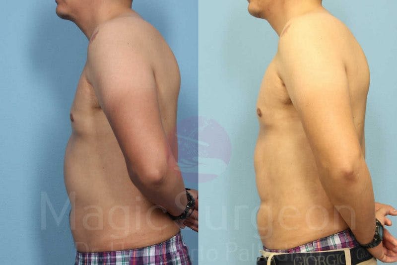 Liposuction Before & After Gallery - Patient 133182342 - Image 3