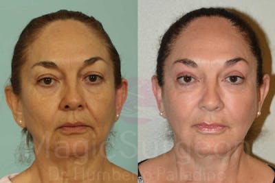 Blepharoplasty Before & After Gallery - Patient 133182343 - Image 1