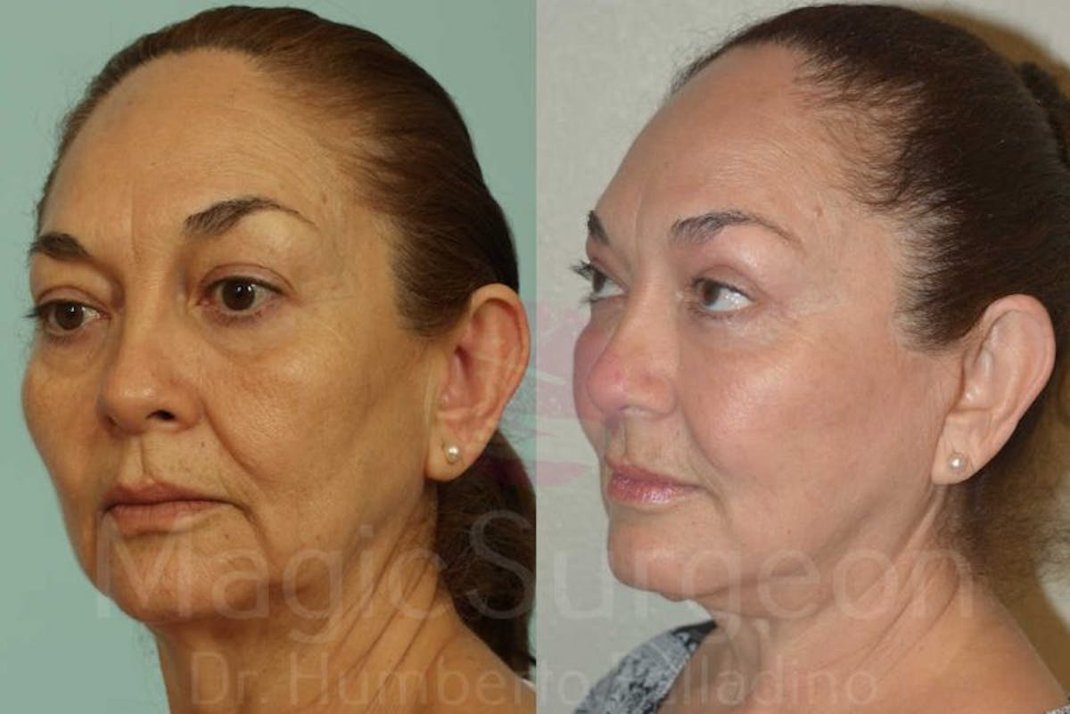 Blepharoplasty Before & After Gallery - Patient 133182343 - Image 2