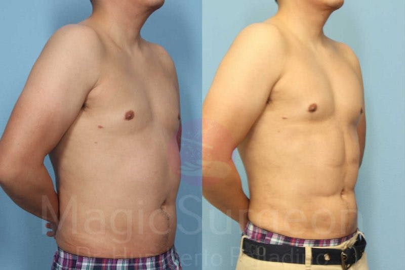 Liposuction Before & After Gallery - Patient 133182342 - Image 4
