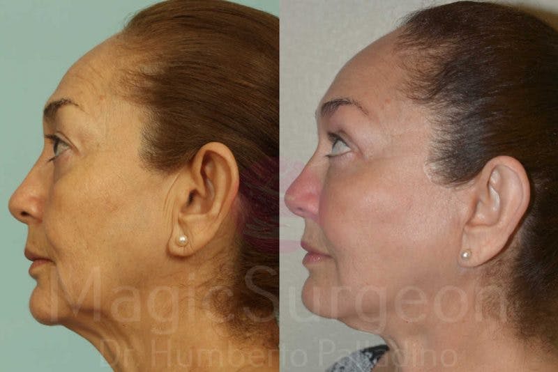 Blepharoplasty Before & After Gallery - Patient 133182343 - Image 3