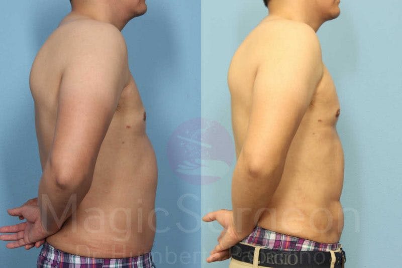 Liposuction Before & After Gallery - Patient 133182342 - Image 5