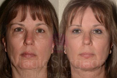 Blepharoplasty Before & After Gallery - Patient 133182344 - Image 1