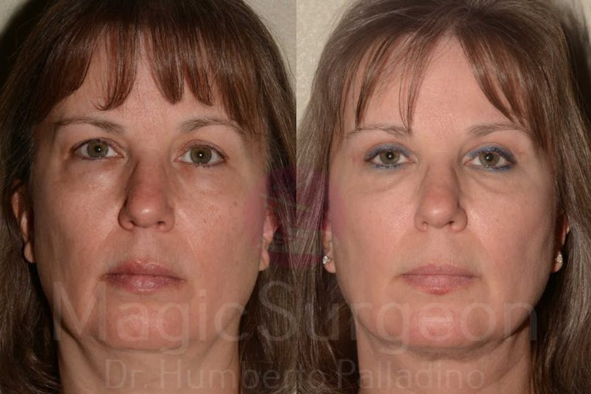 Blepharoplasty Before & After Gallery - Patient 133182344 - Image 1