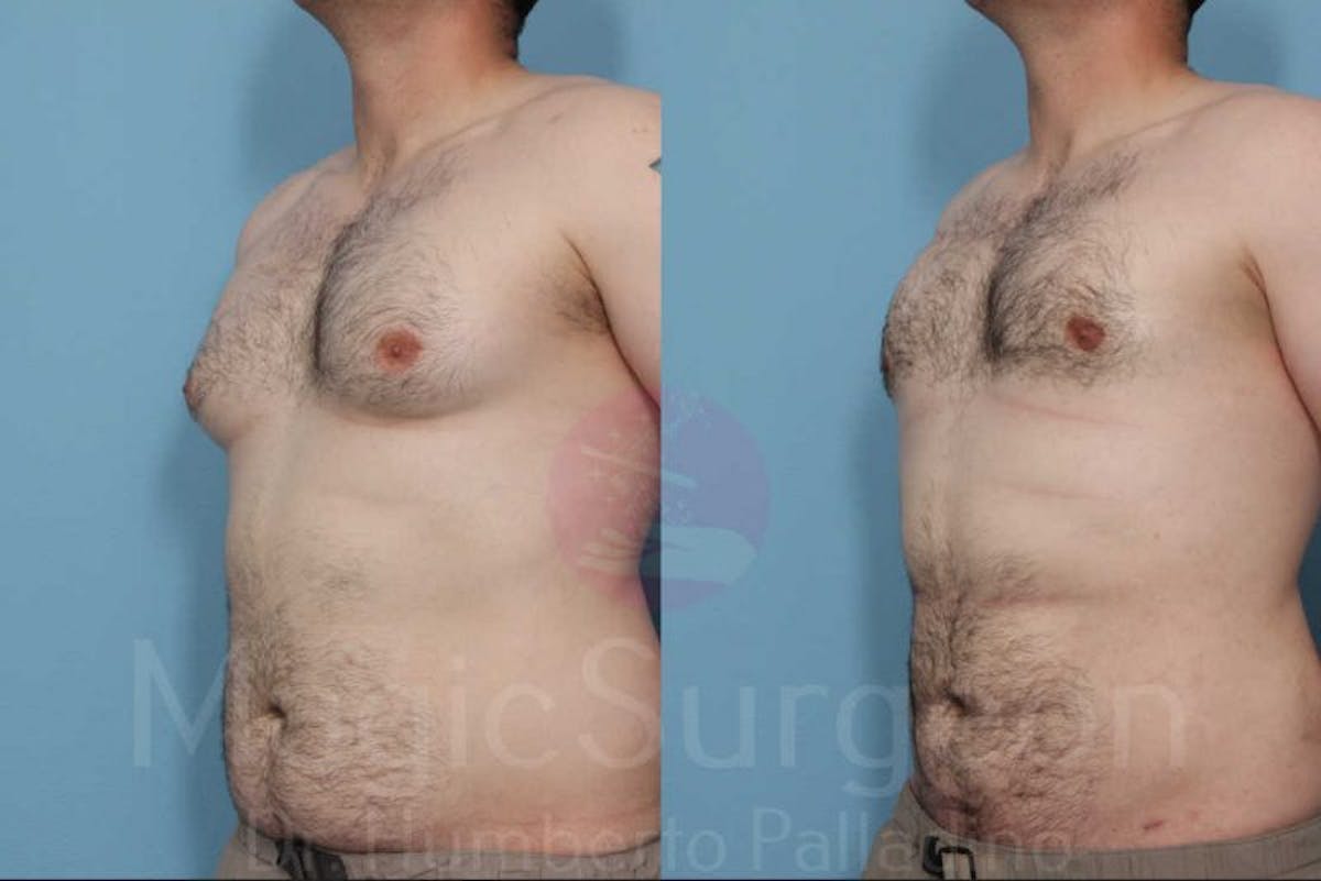 Liposuction Before & After Gallery - Patient 133182345 - Image 2