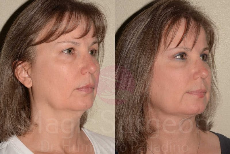Blepharoplasty Before & After Gallery - Patient 133182344 - Image 2