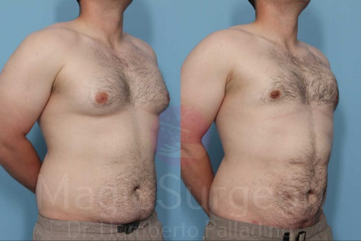 Liposuction Before & After Gallery - Patient 133182345 - Image 1