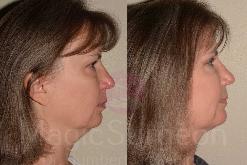 Blepharoplasty Before & After Gallery - Patient 133182344 - Image 3