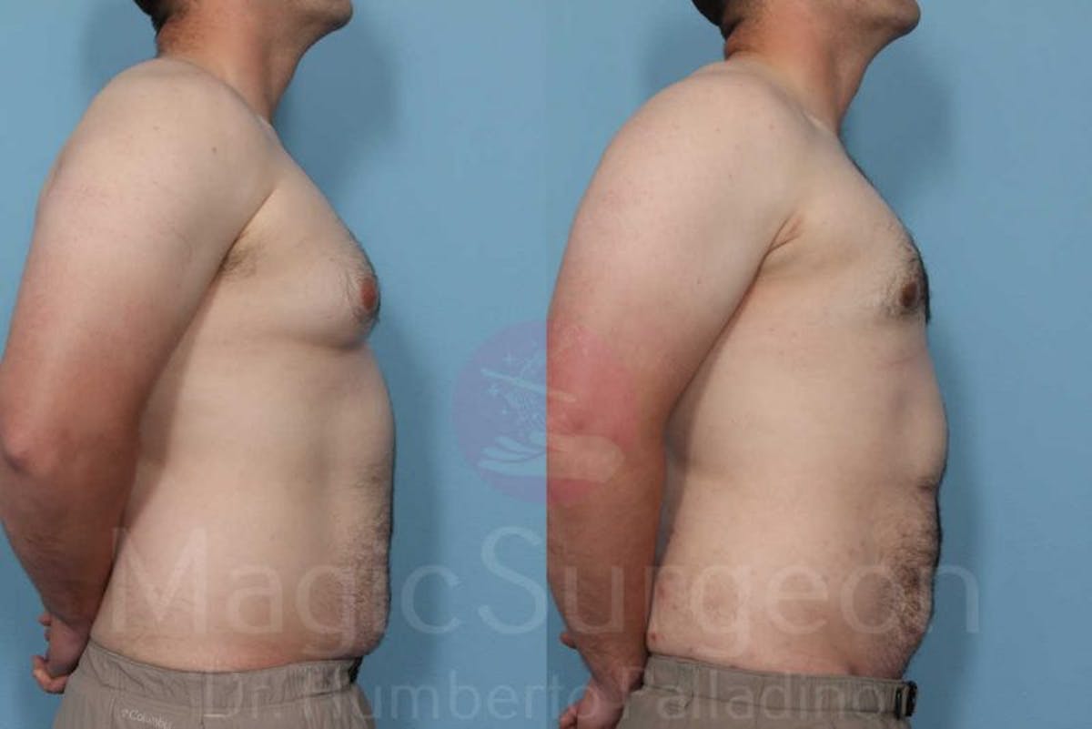 Liposuction Before & After Gallery - Patient 133182345 - Image 3