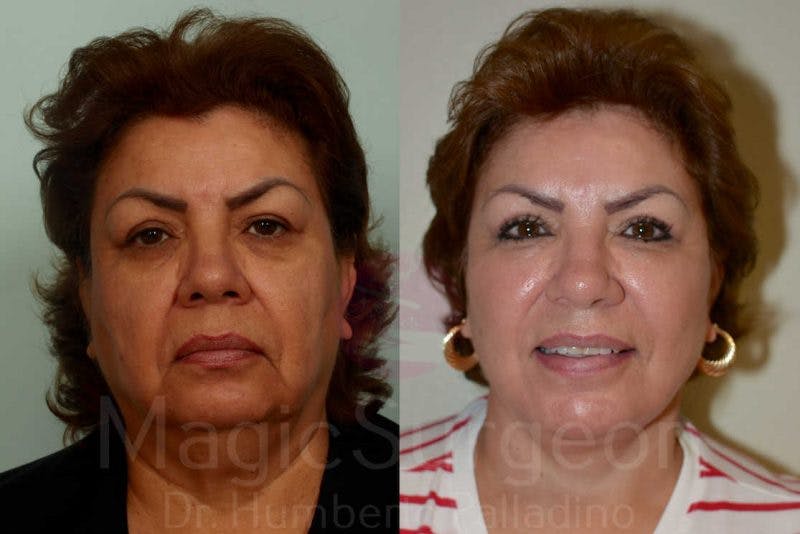 Facelift Before & After Gallery - Patient 133182349 - Image 1