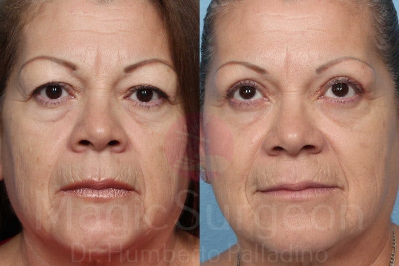 Blepharoplasty Before & After Gallery - Patient 133182348 - Image 1