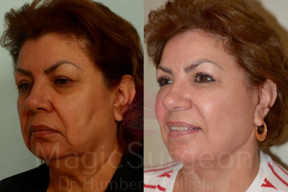 Facelift Before & After Gallery - Patient 133182349 - Image 2
