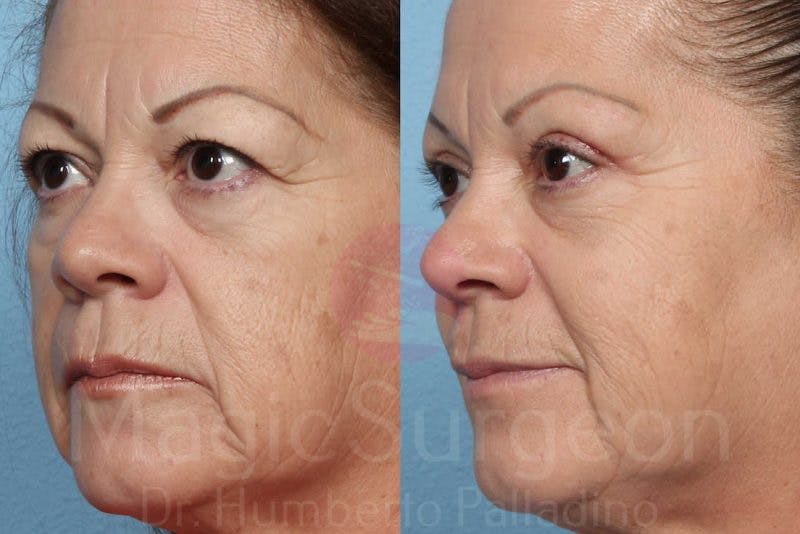Blepharoplasty Before & After Gallery - Patient 133182348 - Image 2