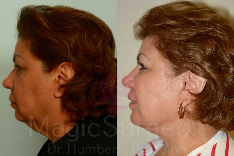 Facelift Before & After Gallery - Patient 133182349 - Image 3
