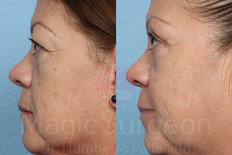 Blepharoplasty Before & After Gallery - Patient 133182348 - Image 3