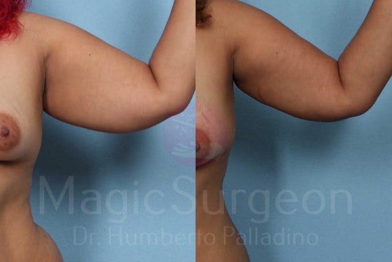 Liposuction Before & After Gallery - Patient 133182350 - Image 3