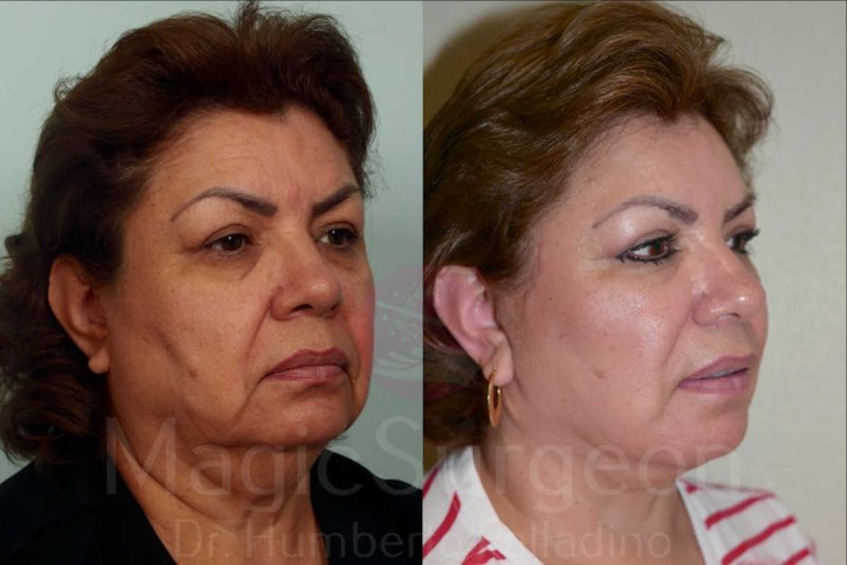 Facelift Before & After Gallery - Patient 133182349 - Image 4