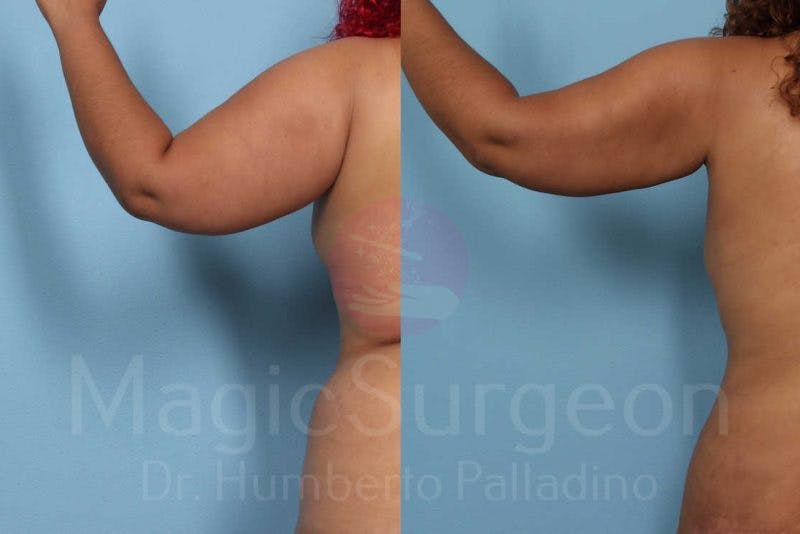 Liposuction Before & After Gallery - Patient 133182350 - Image 1