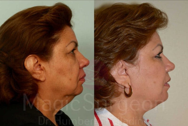 Facelift Before & After Gallery - Patient 133182349 - Image 5