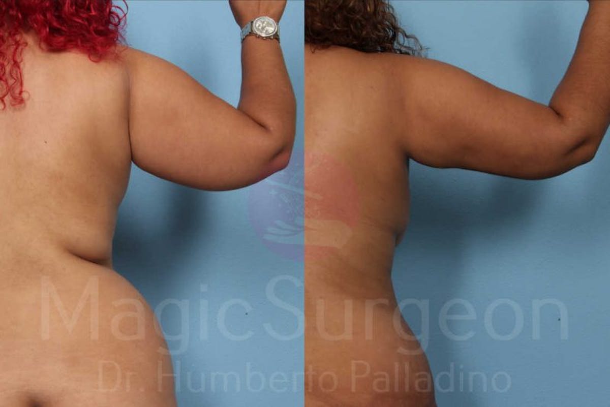 Liposuction Before & After Gallery - Patient 133182350 - Image 4
