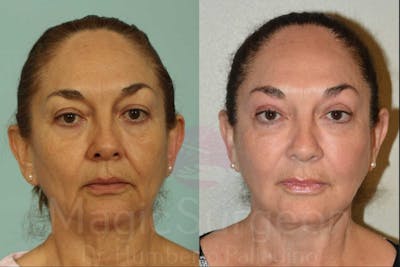 Facelift Before & After Gallery - Patient 133182352 - Image 1