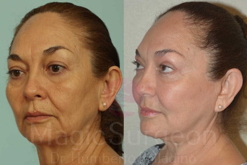 Facelift Before & After Gallery - Patient 133182352 - Image 2