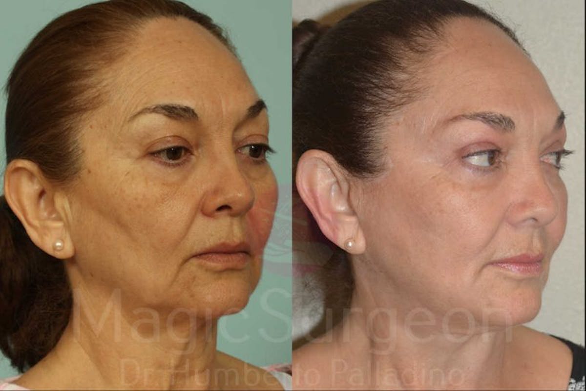 Facelift Before & After Gallery - Patient 133182352 - Image 4