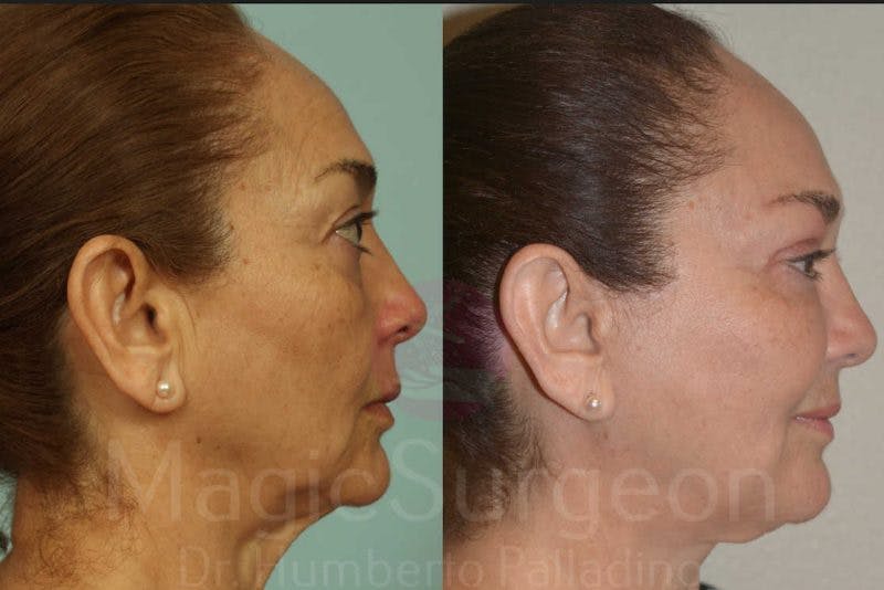 Facelift Before & After Gallery - Patient 133182352 - Image 5