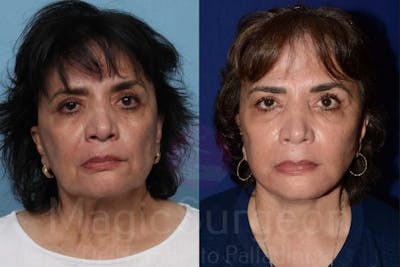 Facelift Before & After Gallery - Patient 133182355 - Image 1
