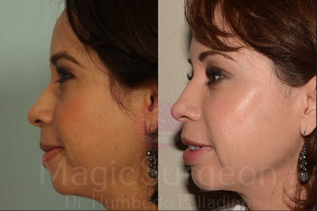 Fat Injections Before & After Gallery - Patient 133182353 - Image 3