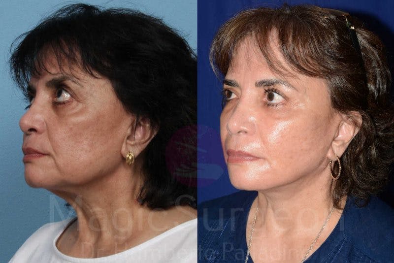Facelift Before & After Gallery - Patient 133182355 - Image 2