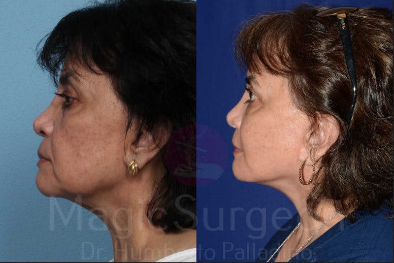Facelift Before & After Gallery - Patient 133182355 - Image 3