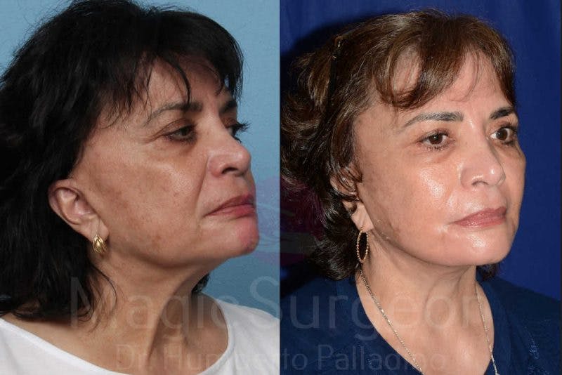 Facelift Before & After Gallery - Patient 133182355 - Image 4