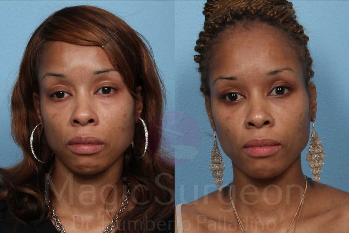 Fat Injections Before & After Gallery - Patient 133182361 - Image 1